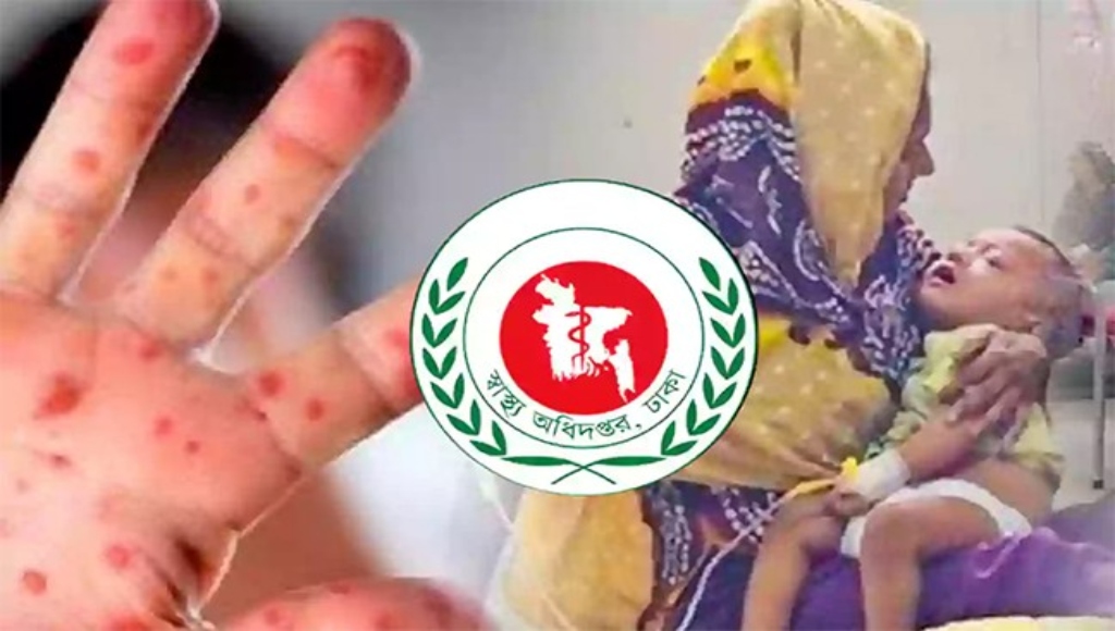 দেশে হাম ও হামের উপসর্গ নিয়ে শিশুর মৃত্যু ৬৬৬